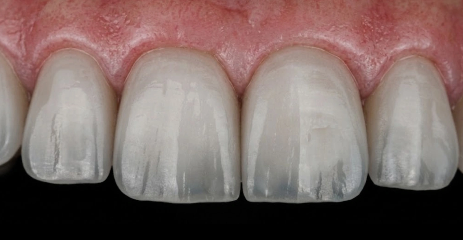 dents transparentes In blog
